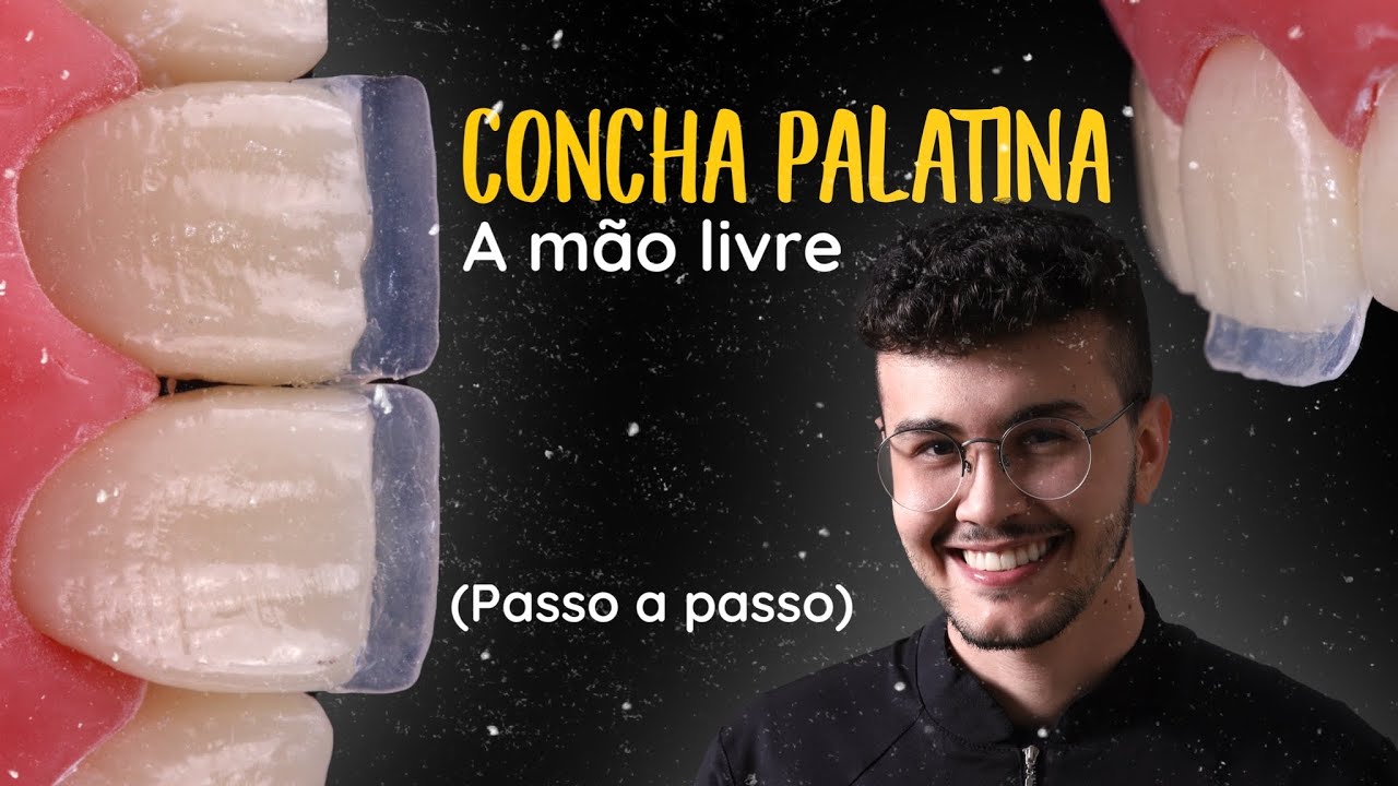 Tutorial de Como Fazer a Concha Palatina a Mão Livre para suas Facetas em Resina Composta