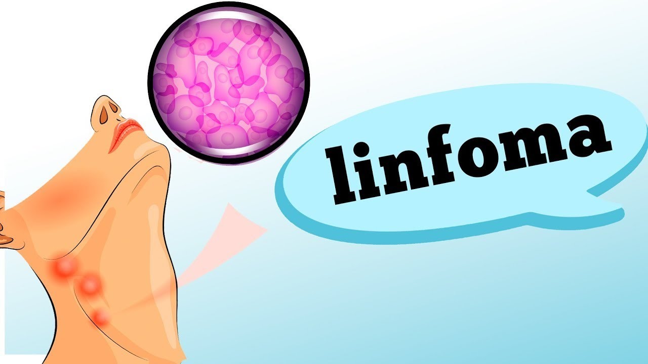 O que é LINFOMA Descubra os sintomas e sinais de alerta!