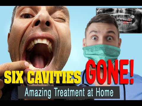 The Treatment for Tooth Decay that Reversed my 5 Cavities in 3 Months!!