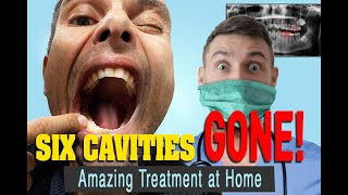 The Treatment for Tooth Decay that Reversed my 5 Cavities in 3 Months!!