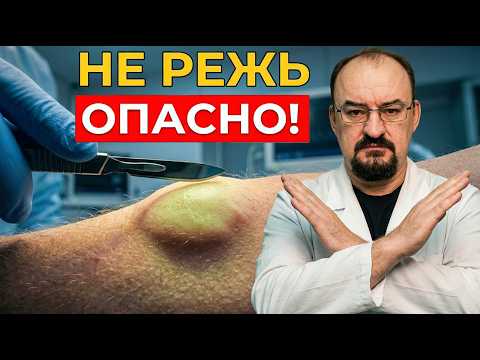 НЕ ВЫРЕЗАЙТЕ ЖИРОВИКИ! Как убрать липому без ножа хирурга
