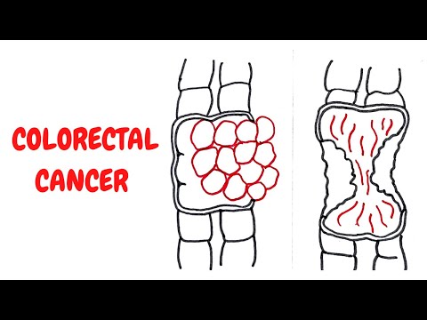 GASTRIC CARCINOMA II GIT II ROBBINS 10TH E II PATHOLOGY LECTURES II DrJIBRANAHMED