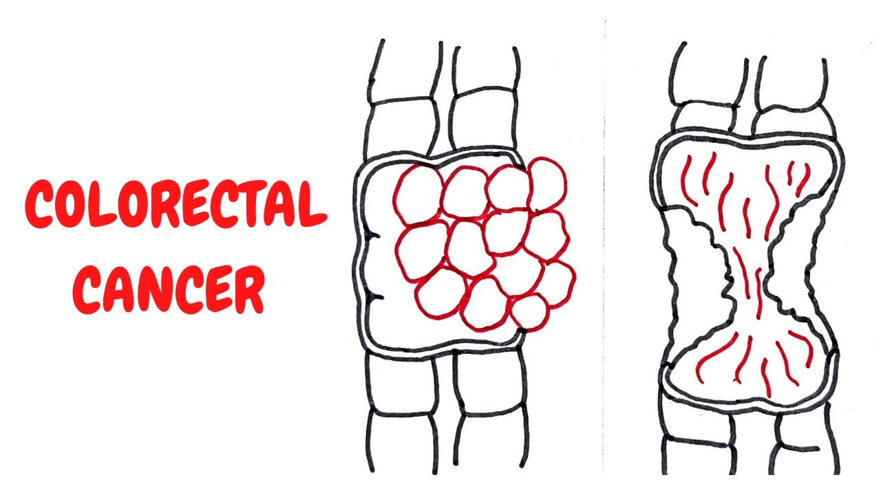 COLORECTAL CANCER II GIT II ROBBINS 10TH E II PATHOLOGY LECTURES II @DrJIBRANAHMED