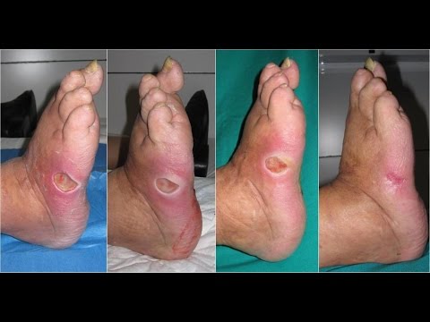 Tapeworm diyeta Ay posible na mawalan ng timbang sa binti ng water aerobics