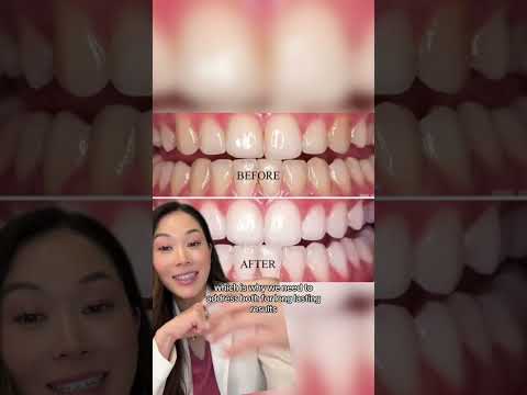 What whitening products work for different stains on teeth. #teethwhitening #dentist #whiteteeth