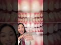What Whitening Products Work For Different Stains On Teeth Teethwhitening Dentist Whiteteeth