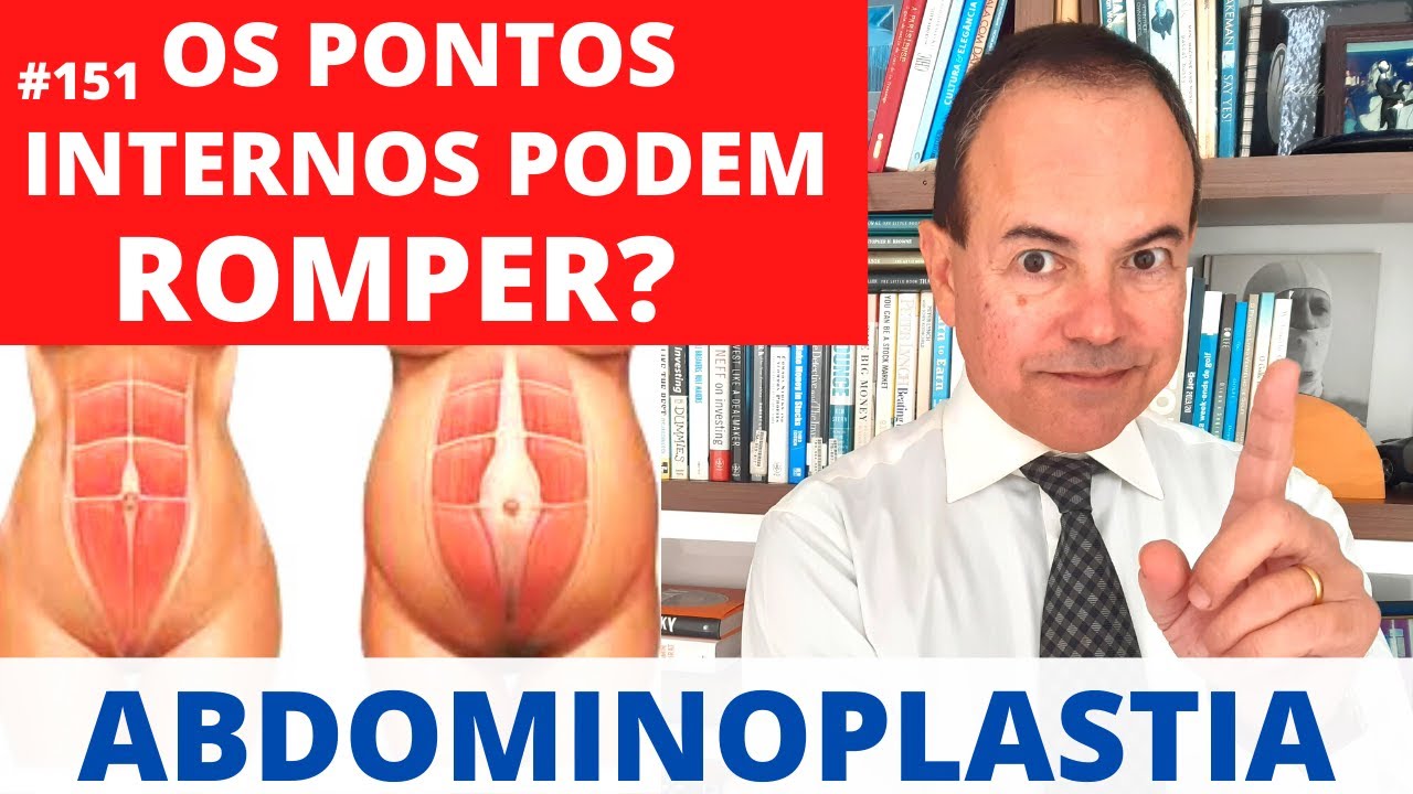 Os pontos do Abdômen podem abrir após a ABDOMINOPLASTIA? [Cirurgia Plástica]