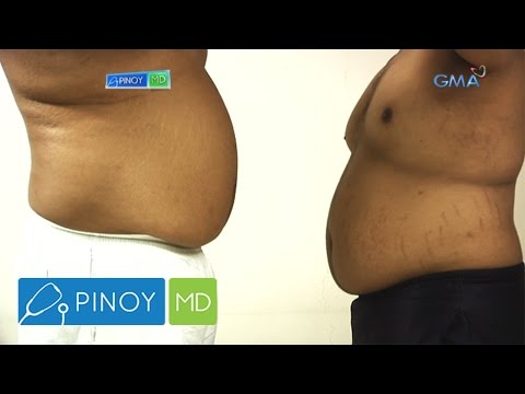 Isang hanay ng mga pagsasanay upang mawala ang timbang sa bahay para sa mga bata Xenical capsules 42 bili