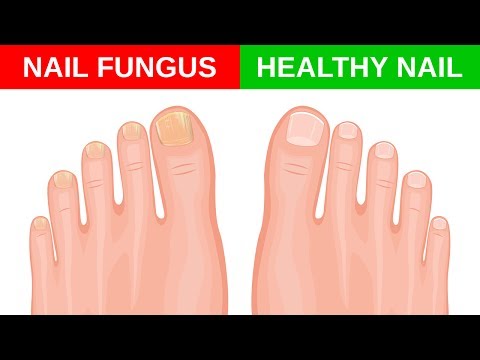 Paggamot ng pasalingsing kuko ng video Anumang mga solusyon ng kuko halamang-singaw
