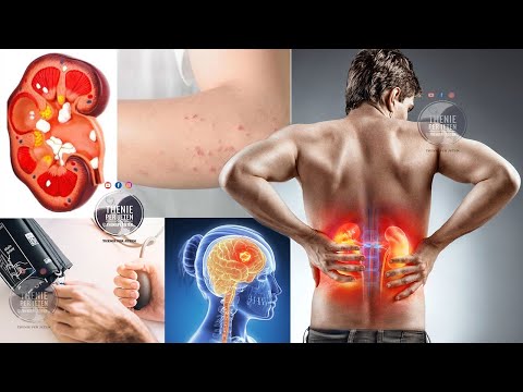 Nese i keni keto shenja ne trup, tregoni kujdes pasi veshkat tuaja po vuajne nga kjo semundje