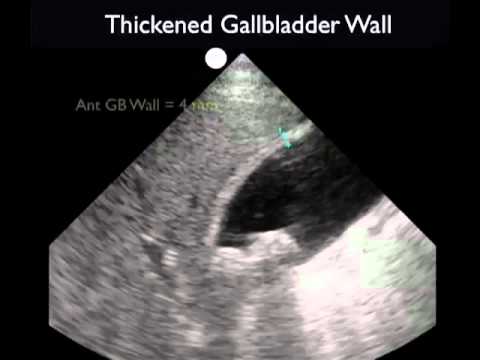 How To: Gallbladder Ultrasound Part 3 - Acute Cholecystitis Case Study Video