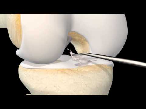 Osteoartrita articulației umărului