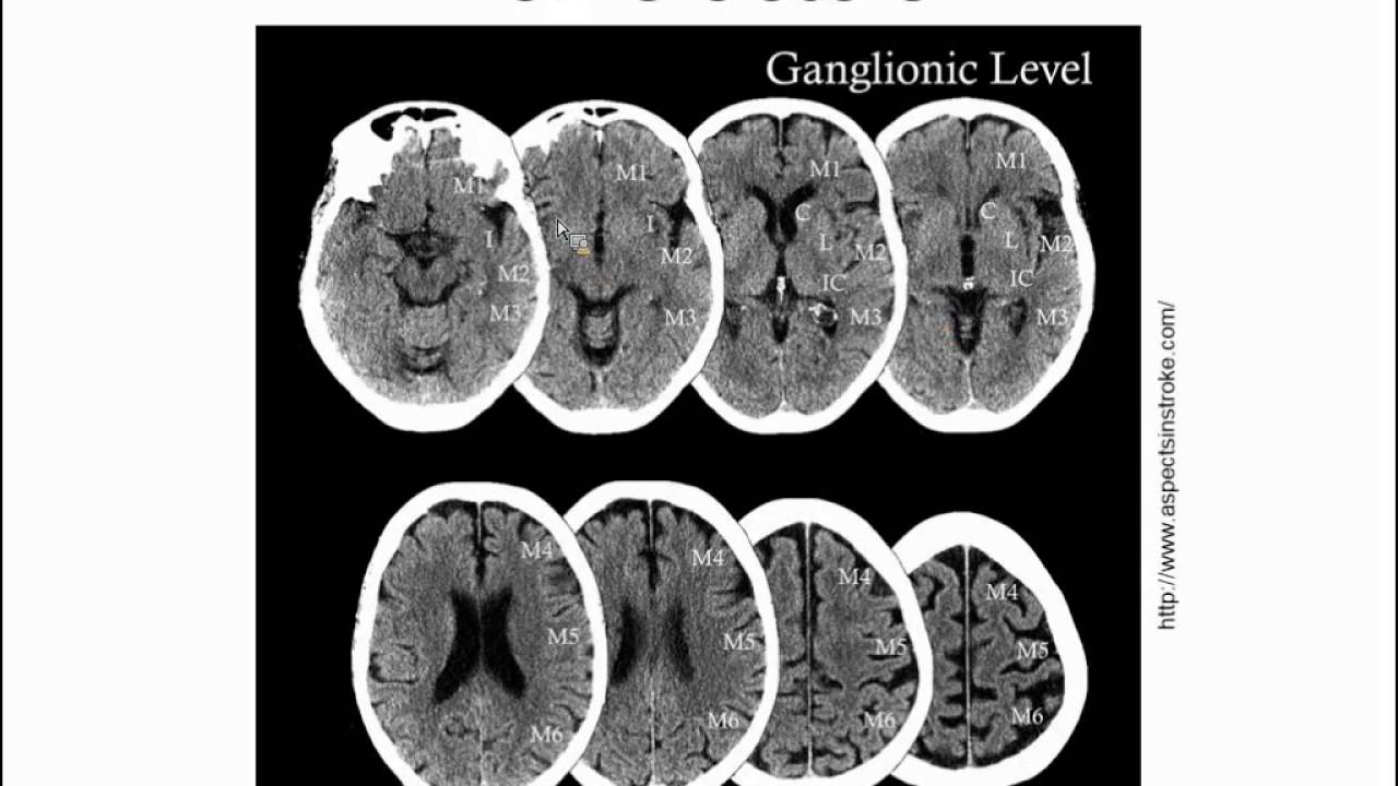 Kyra Becker, M.D. - 5 New Things in Stroke