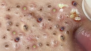 Loan Nguyen Acne Treatment 5m