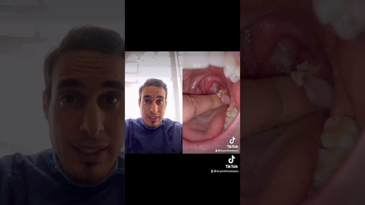 Watch ⛔️¿Qué son estas BOLAS BLANCAS en la garganta Causa y tratamiento de los TONSILOLITOS #shorts Now ⛔️¿Qué son estas BOLAS BLANCAS en la garganta Causa y tratamiento de los TONSILOLITOS #shorts