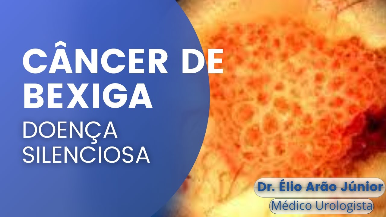 Câncer de bexiga | DOENÇA SILENCIOSA | Dr. Élio Arão Júnior | Urologista