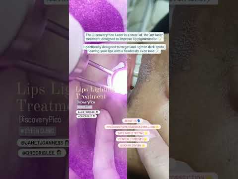 Lip Lightening Treatment in Subang Jaya 