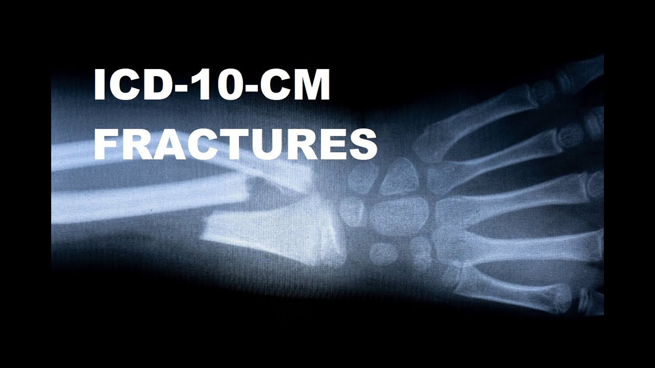 What is the ICD 10 code for proximal tibial fracture? Tipseri