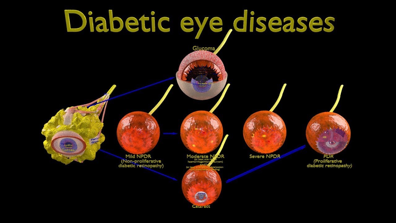 Diabetic eye diseases model 3D Model