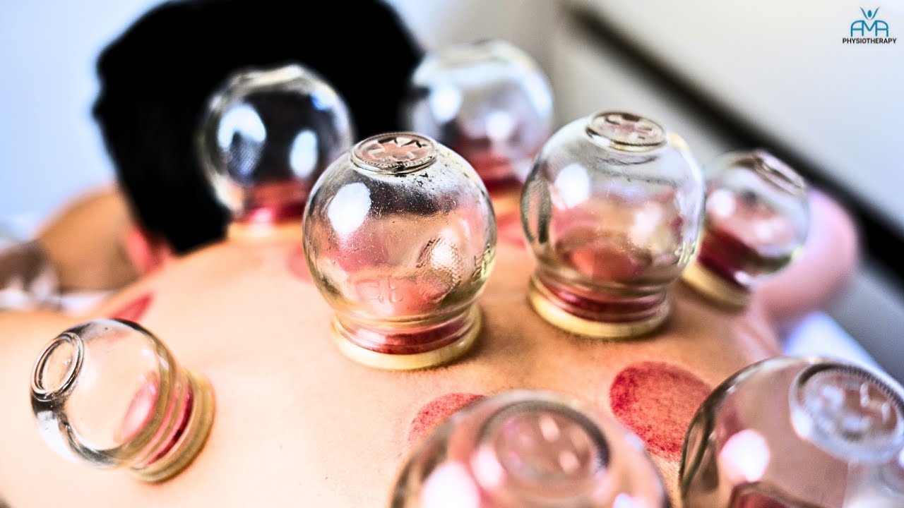 Debunking Cupping: Does It Really Work? | The Truth Revealed