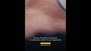 Scar and Stretch Marks Removal with Bi One