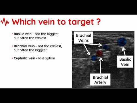 Midline insertion_PRESENTATION
