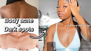 HOW TO GET RID OF BODY ACNE/ DARK SPOTS - Fast and Effective‼️