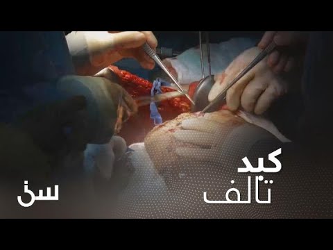 عملية جراحية لاستخراج كبد تالف من جسم إنسان  - العراق