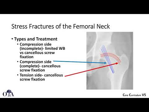 Femoral neck fractures in patients younger than 50 years - 3 of 3