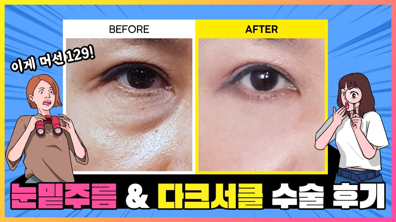 눈밑주름, 다크서클 한번에 없앨 수 있다고? 지금 내 눈밑은????? | 키다리성형외과