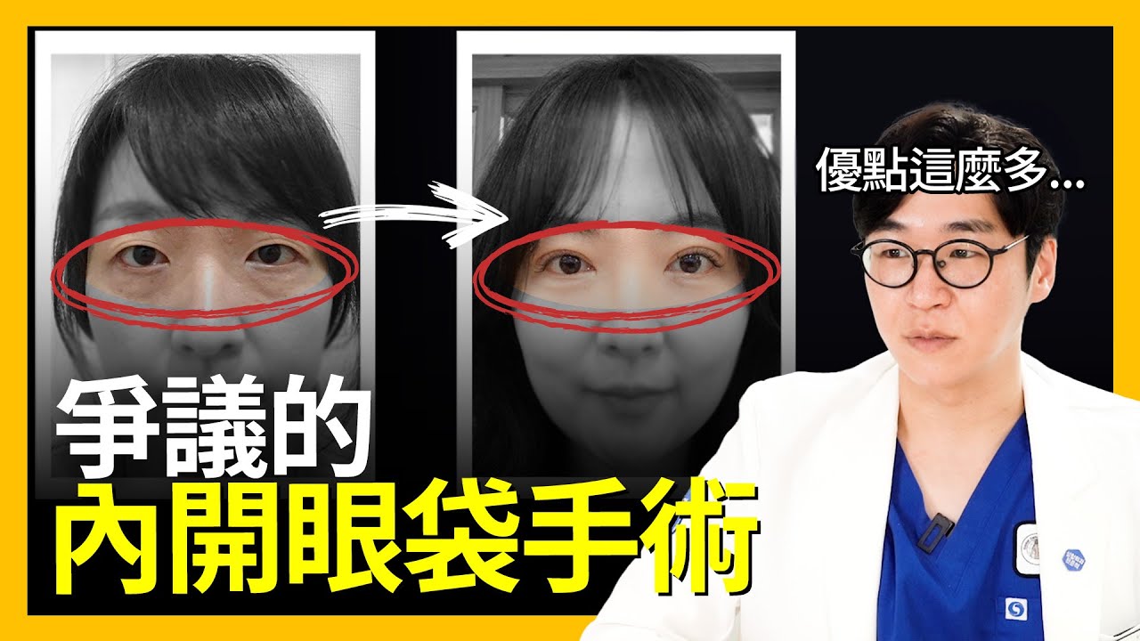 解密眼袋手術：權威院長的專業講解