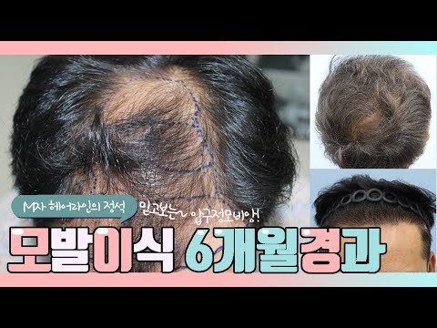 40대 중반 남성,비절개 5000모, M-O자 모발이식 6개월 경과영상!