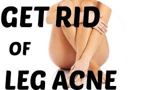 HOW TO GET RID OF ACNE ON YOUR LEGS