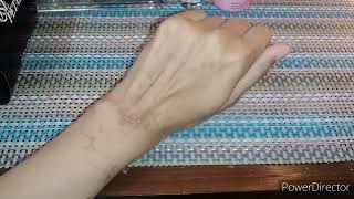 How to remove mehandi burns | mehandi scars treatments |