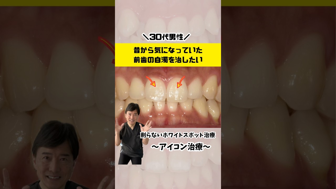 30代男性・前歯の白濁を治したい！　#なかの歯科 #岡山歯医者 #ホワイトスポット #アイコン治療