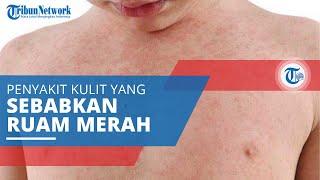 Rubella, Penyakit Menular karena Virus Menyebabkan Ruam Kemerahan pada Kulit