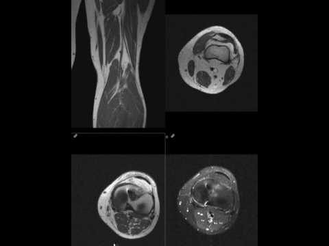 Good peroneal MR neurography