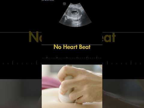 Ultrasound showing a  9 weeks fetus with no Heart Beat