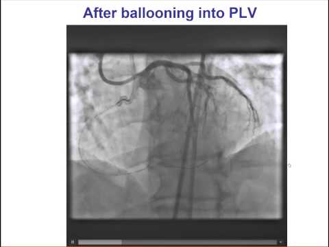 Problem Solving In Antegrade dissection_Re-entry CTO interventions