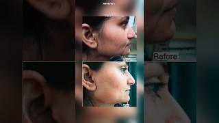 Easy natural tricks to remove facial hair without pain  #shorts #facialhair #fyp #kpop #beauty #888