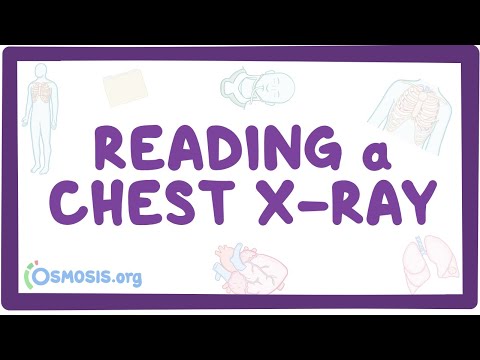 Reading a chest X-ray