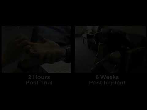 Dr. Georgios Matis - Neuromodulation -Spinal cord injury before & after intrathecal baclofen therapy