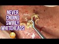 Blackhead and whitehead extractions (relaxing & satisfying!)