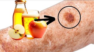 Apple Cider Vinegar will Remove Age Skin Spots if You do this...