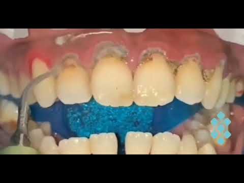 Limpieza Dental de Sarro