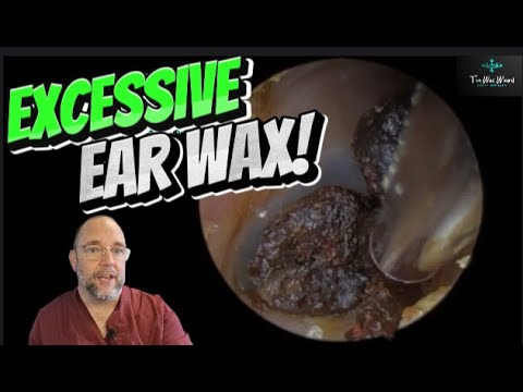 EXCESSIVE EAR WAX! 266 #ear #earwax #earwaxremoval #earcleaning #fyp  #asmr #asmrearwax #satisfying