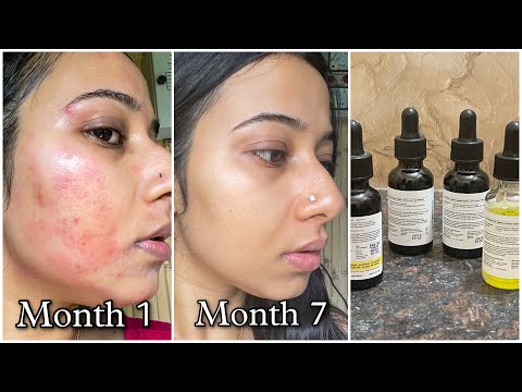 Best Face Serums that helped me to remove Pimple Marks, Acne Scars, Dark Spots, PIH & PIE