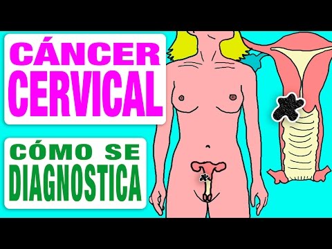 Cáncer de cérvix, importancia del diagnóstico precoz