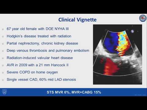 Transseptal transcatheter mitral valve replacement in severe mitral annular calcification