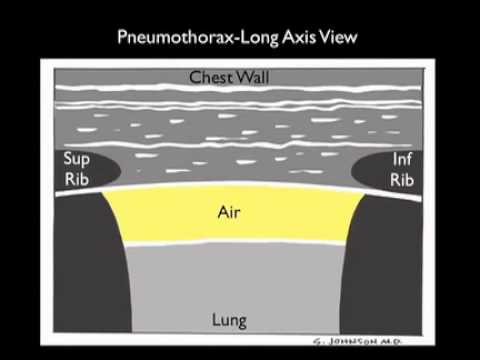 How To: Ultrasound for Pneumothorax Case Study Video